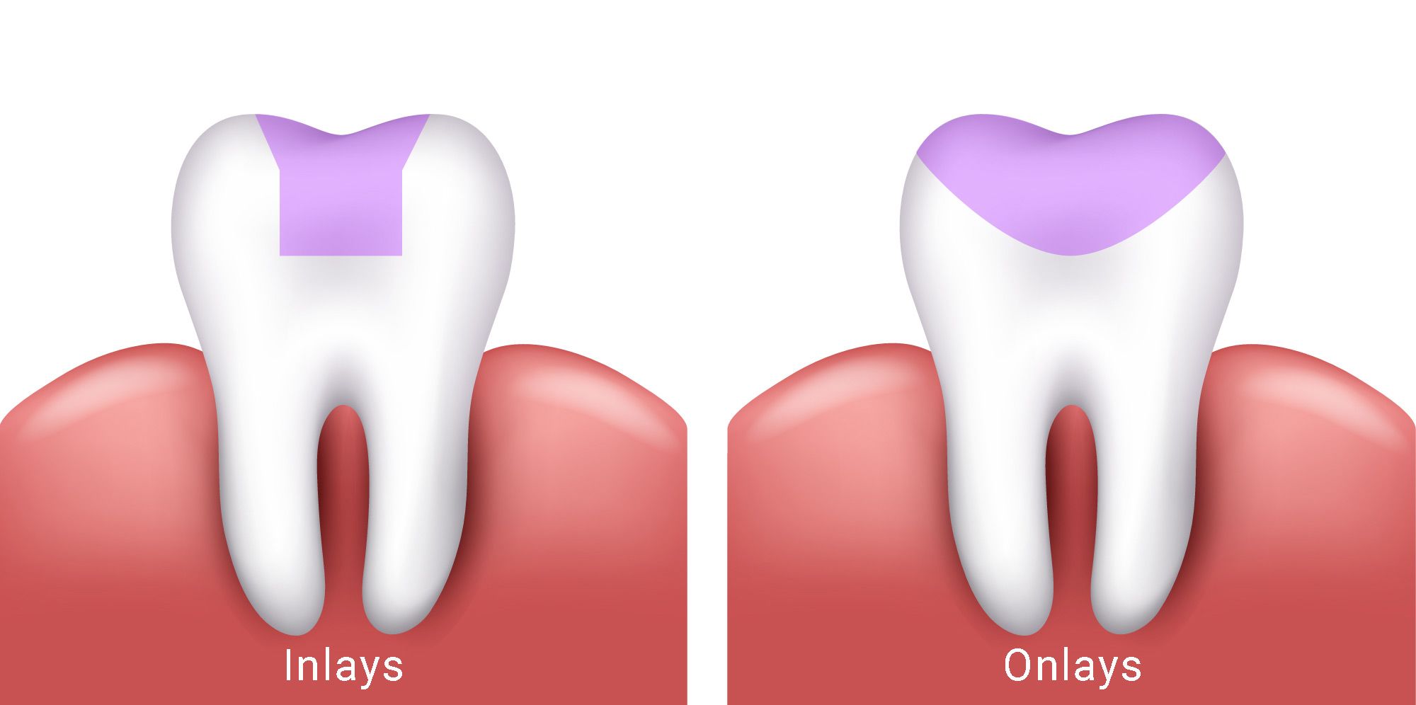 Illustration of an inlay and onlay